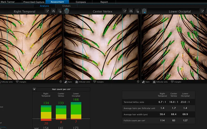 Hairmetrix Canfield